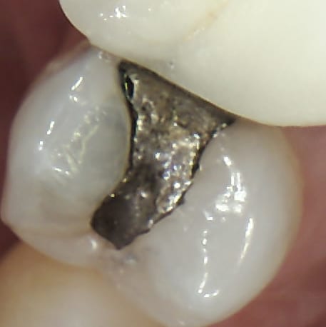 margin gap amalgam filling