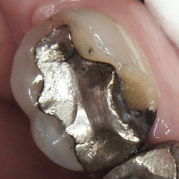 Fracture amalgam filling
