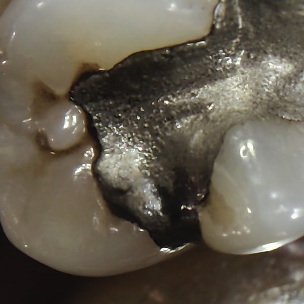secundary caries amalgam filling