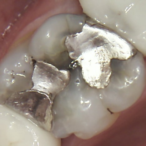 Amalgam Crack