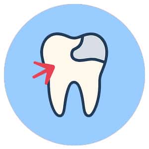 Margin Gap Amalgam Filling