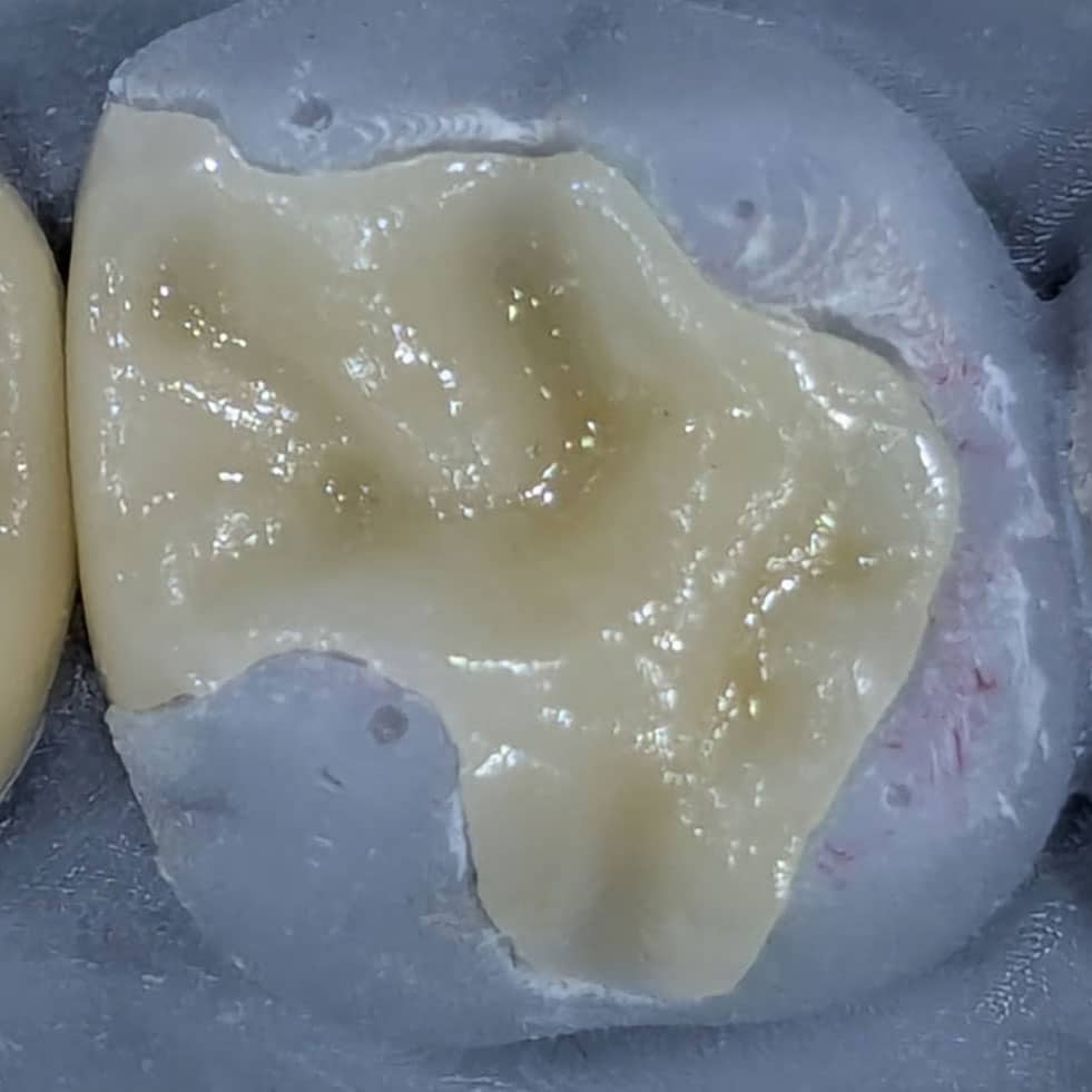 Onlay dental ceramic dentist Stuttgart Vaihingen