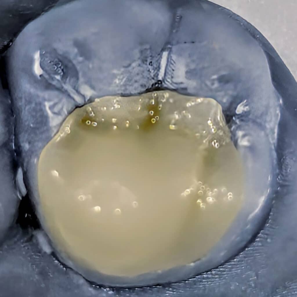 Overlay dental ceramic dentist Stuttgart Vaihingen