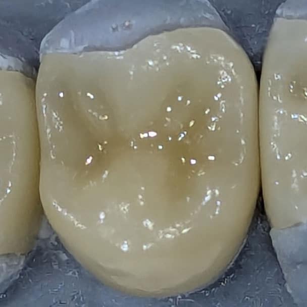 partial crown dental ceramic dentist Stuttgart Vaihingen