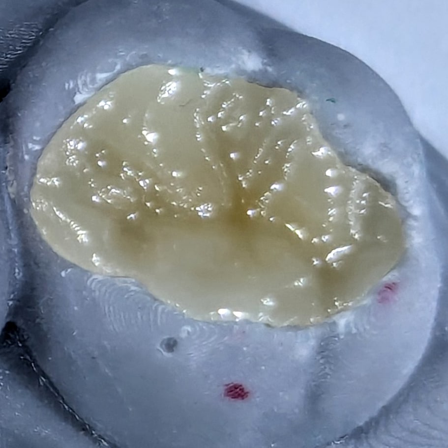 Inlay dental ceramic dentist Stuttgart Vaihingen